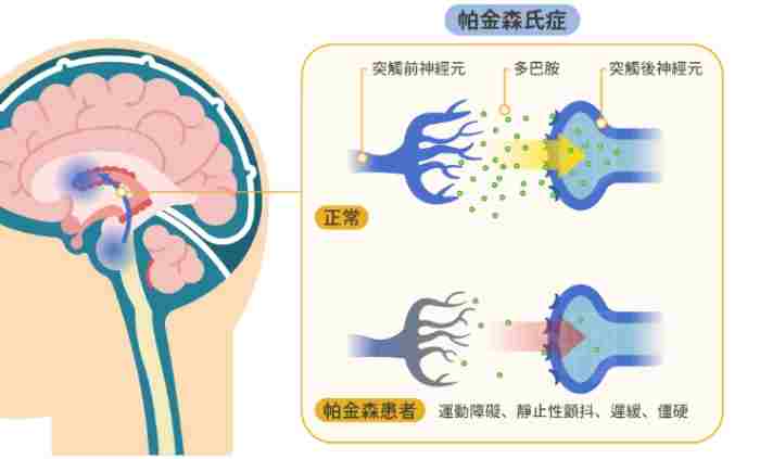 帕金森治療