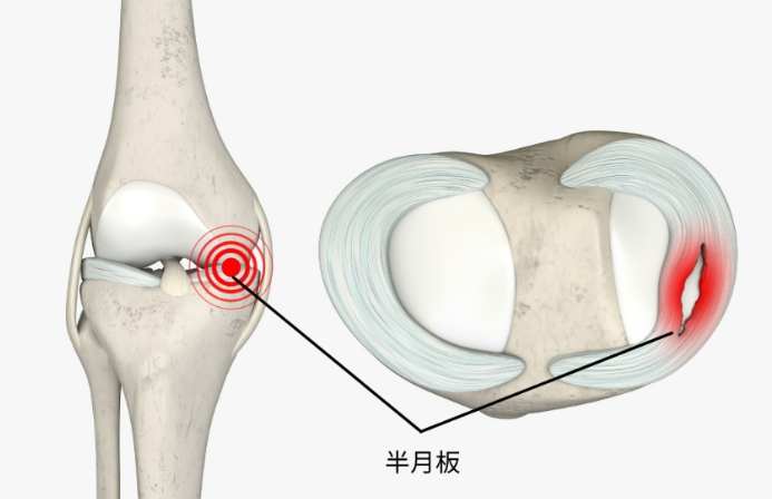 半月板受傷恢復時間 半月板受傷恢復時間
