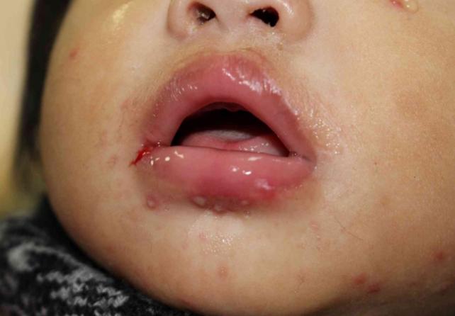 幼兒口腔潰瘍發燒 幼兒口腔潰瘍發燒
