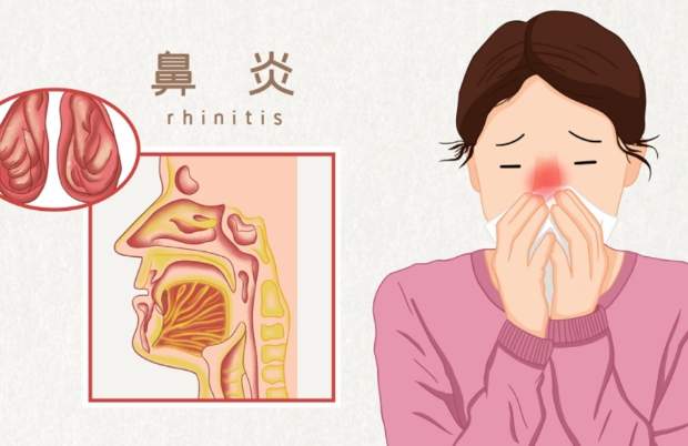 中藥治療過敏性鼻炎 中藥治療過敏性鼻炎