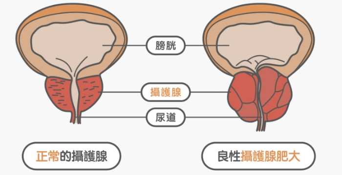 中藥治療攝護腺肥大 中藥治療攝護腺肥大