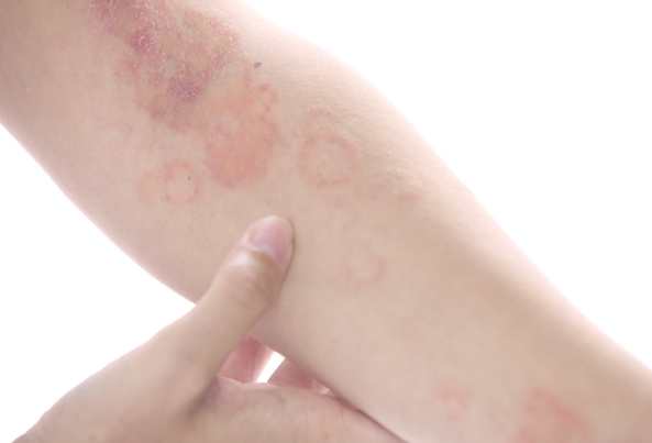 中藥治療異位性皮膚炎 中藥治療異位性皮膚炎