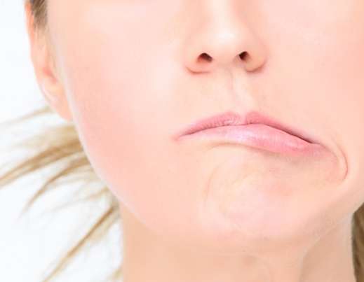 顏面神經麻痺