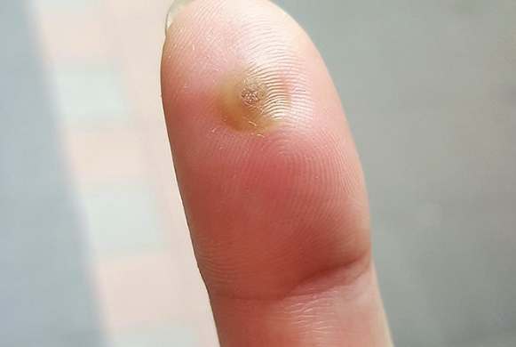 冷凍治療費用 冷凍治療費用