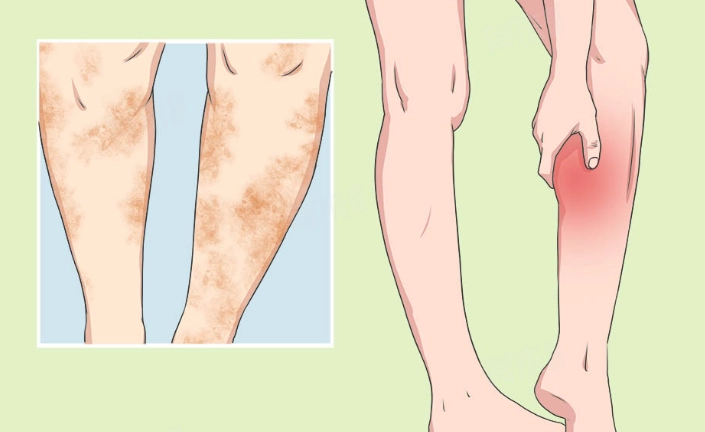 大腿筋膜發炎 康復時間 大腿筋膜發炎 康復時間