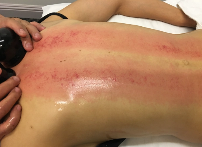 滑罐療法