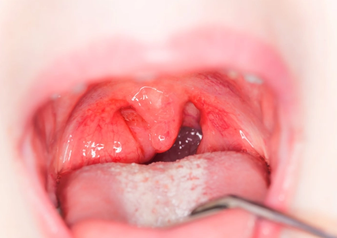 扁桃腺發炎緩解方法 扁桃腺發炎緩解方法