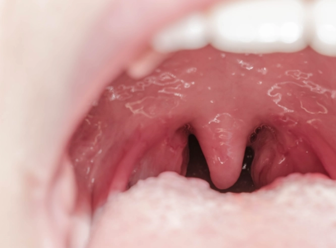 扁桃腺發炎症狀 扁桃腺發炎症狀