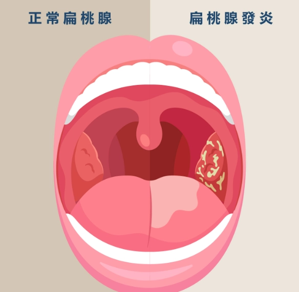 扁桃腺發炎自行康復 扁桃腺發炎自行康復