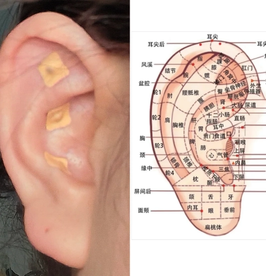 耳穴貼使用方法 耳穴貼使用方法