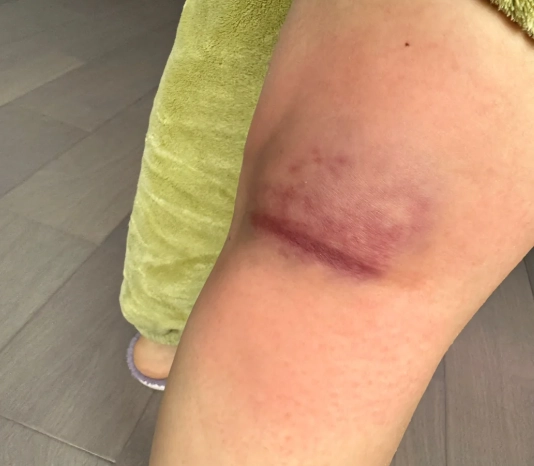 膀胱經堵塞 膀胱經堵塞