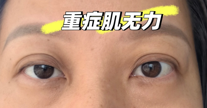 MG死亡率