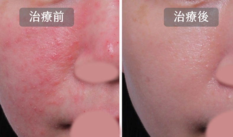 蠕形螨治療 蠕形螨治療