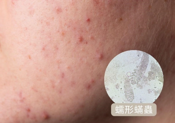 蠕形蟎蟲治療 蠕形蟎蟲治療
