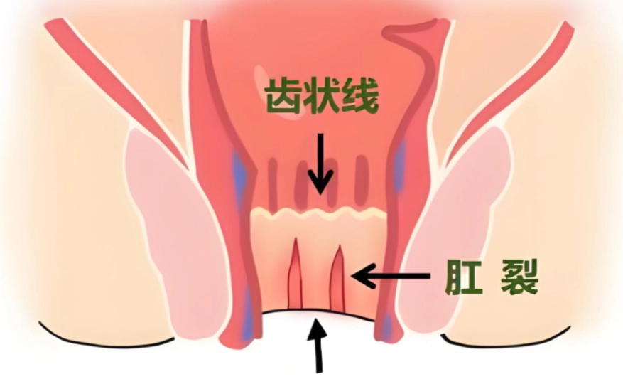 肛裂恢復時間