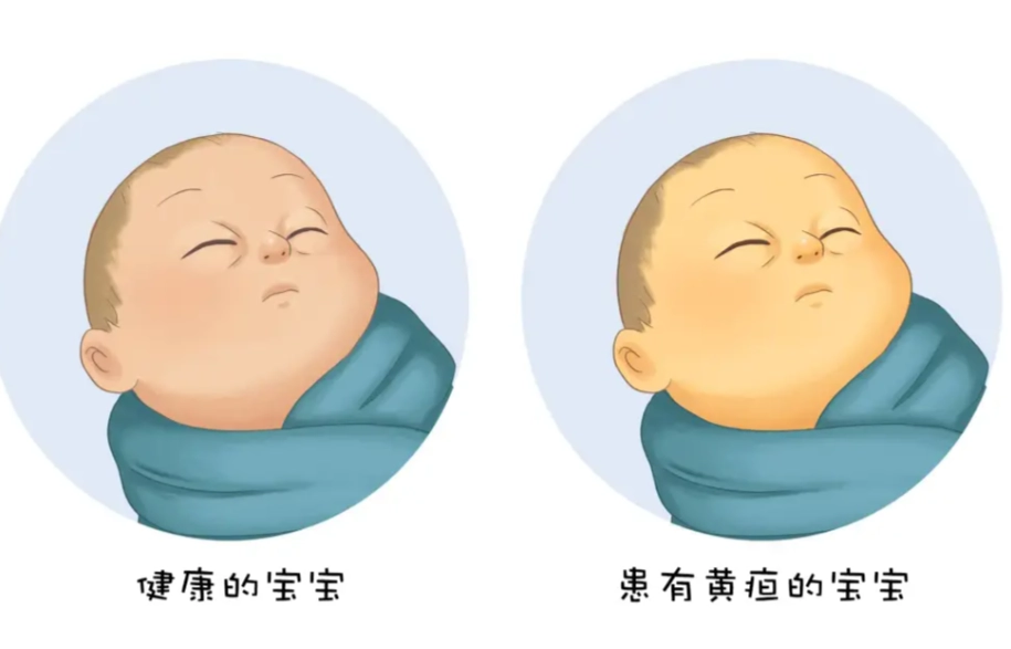 嬰兒黃疸症狀 嬰兒黃疸症狀