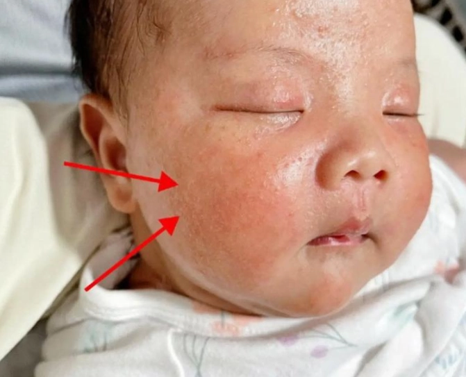 新生兒胎毒症狀 新生兒胎毒症狀