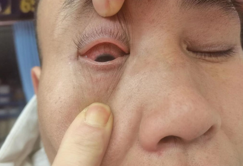虹彩炎恢復時間 虹彩炎恢復時間