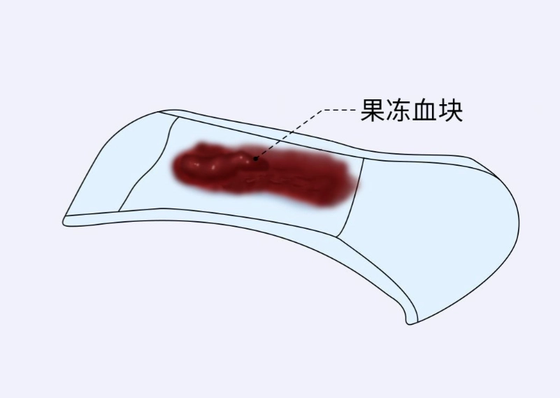 月經血塊原因 月經血塊原因