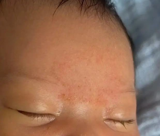 新生兒脂漏性皮膚炎症狀