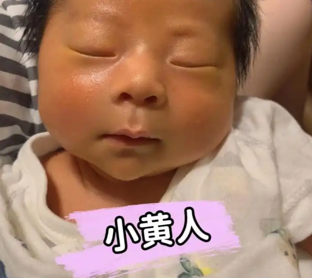 新生兒黃疸 新生兒黃疸