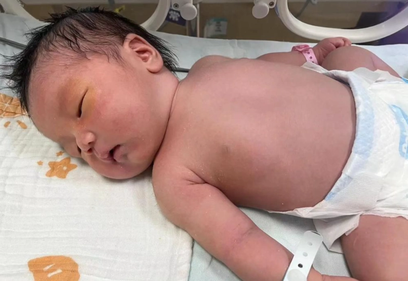 新生兒黃疸指數 新生兒黃疸指數