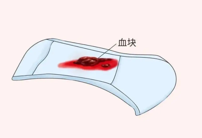 月經血塊原因 月經血塊原因