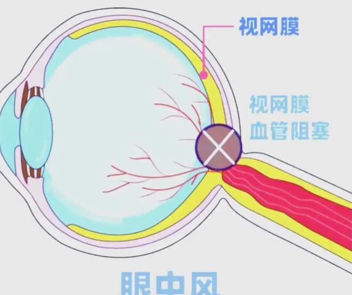 眼中風治療 眼中風治療
