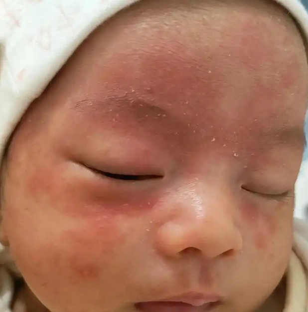 新生兒臉上紅疹 新生兒臉上紅疹