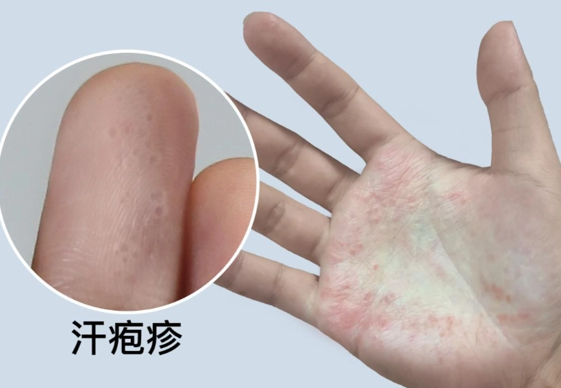 汗皰疹治療時間 汗皰疹治療時間
