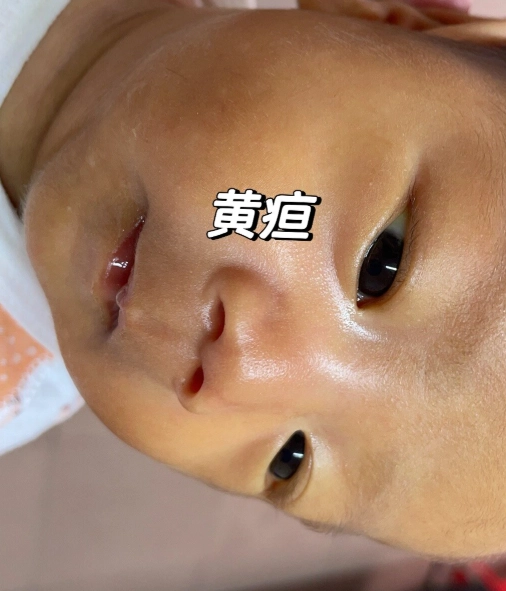 新生兒黃疸治療 新生兒黃疸治療