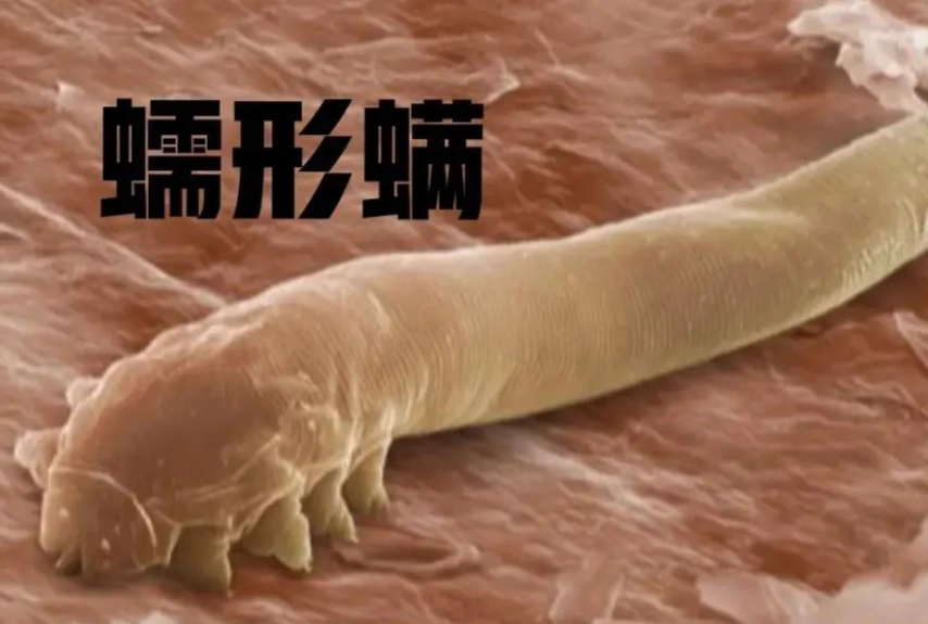 蠕形蟎蟲症狀 蠕形蟎蟲症狀