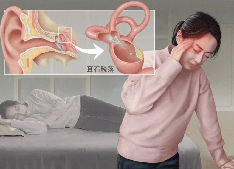耳石症恢復時間 耳石症恢復時間