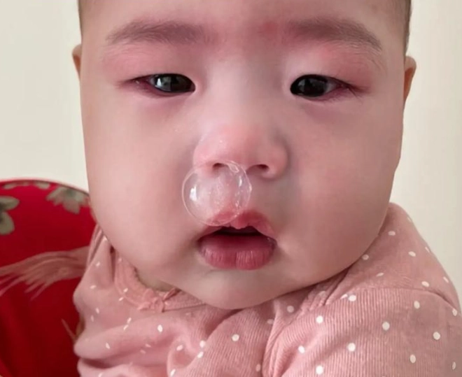 嬰兒流鼻水看醫生 嬰兒流鼻水看醫生
