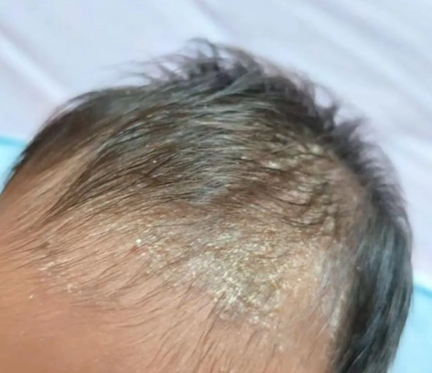 脂漏性皮膚炎 嬰兒 脂漏性皮膚炎 嬰兒