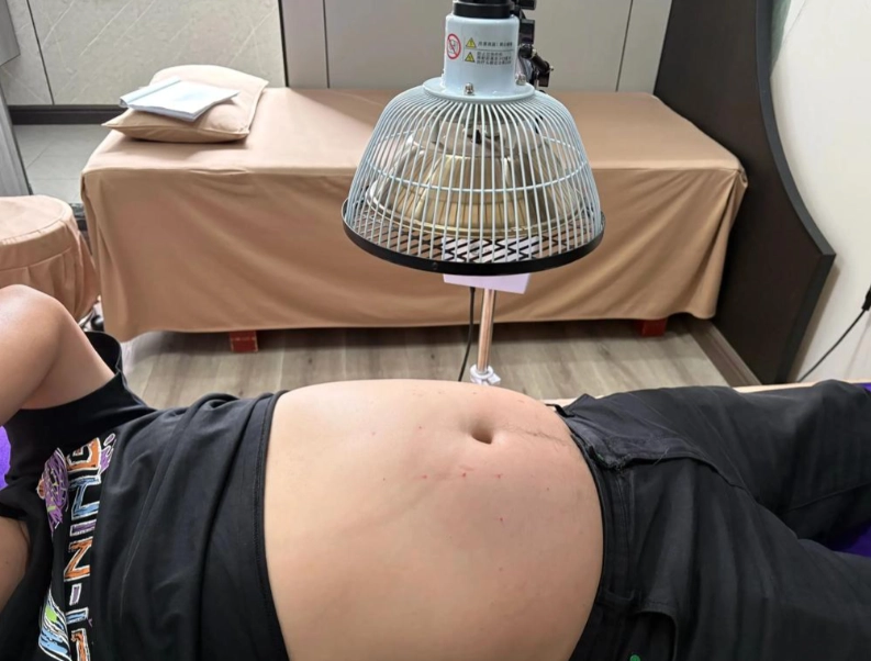 穴位埋線療法 穴位埋線療法