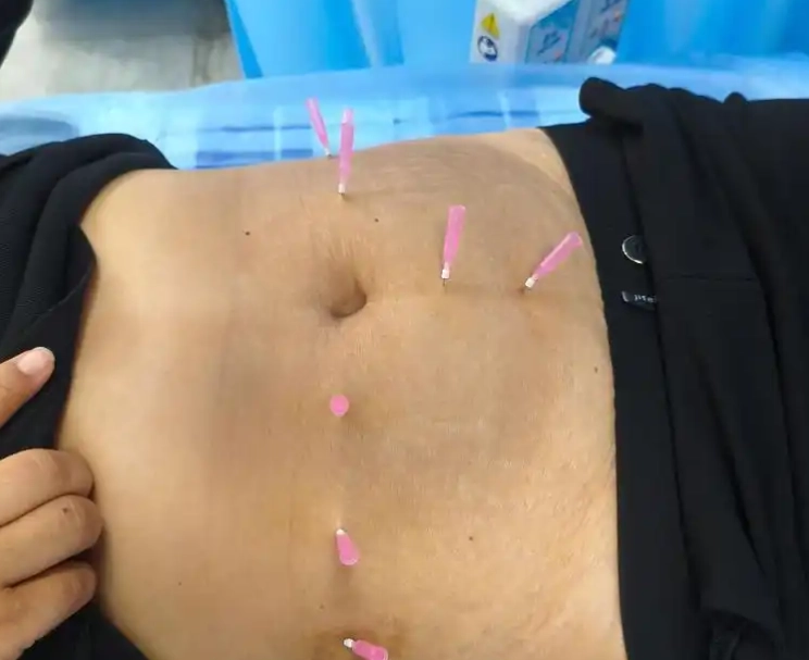 埋線減肥