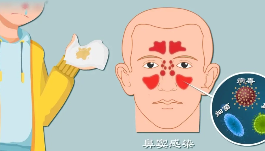 鼻竇炎症狀 鼻竇炎症狀