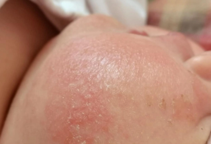 嬰兒脂漏性皮膚炎護理 嬰兒脂漏性皮膚炎護理